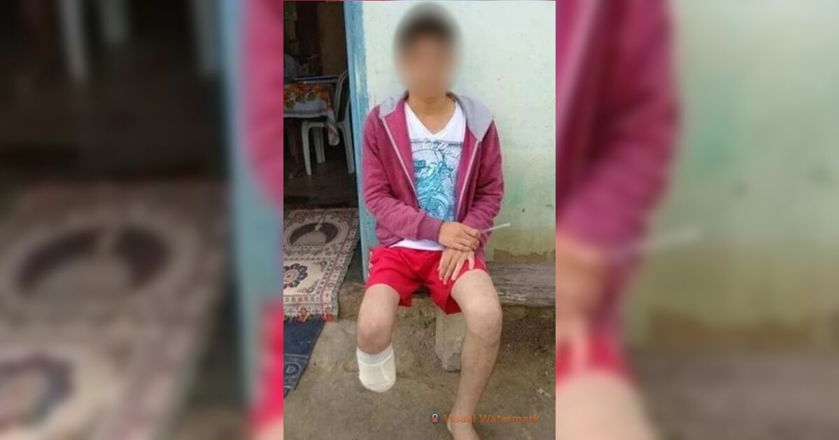 Funcionário público amputa própria perna para dar golpe de R$ 1,5 milhão no seguro
