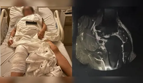 Idosa acorda de cirurgia e descobre que prótese foi colocada no joelho errado no PR