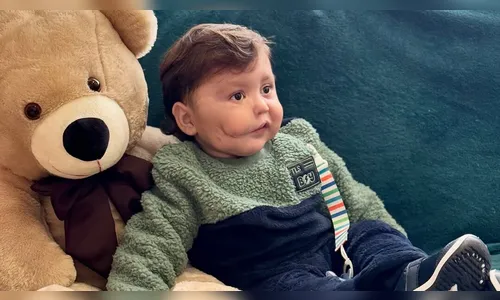 Bebê que nasceu com tumor raro no rosto precisa passar por novas cirurgias no PR