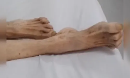 Idosa abandonada desnutrida por filho advogado morre em hospital