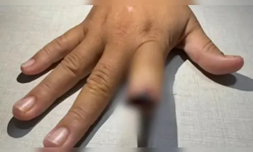 Homem arranca dedo de namorada com mordida durante briga