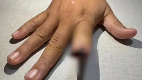 Mulher teve dedo arrancado pelo namorado