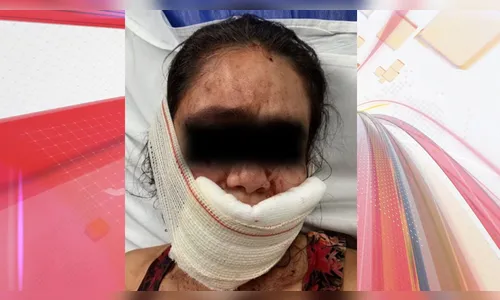 Mulher tem lábios arrancados com mordidas após rir do namorado