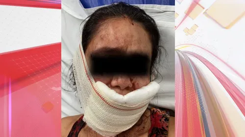 Vítima passou pela primeira cirurgia de reconstrução da face