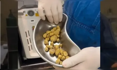 Médico retira cálculos renais de paciente; vídeo impressiona