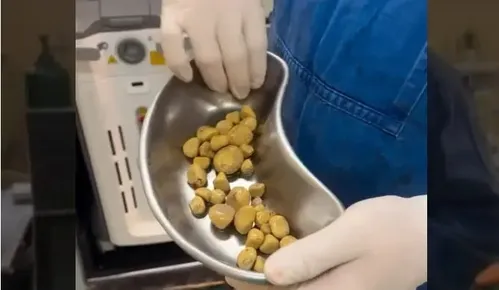 No post, o médico explicou que o excesso de refrigerantes pode favorecer a formação de cálculos tanto nos rins quanto na bexiga