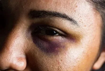 A mulher sofreu ferimentos no rosto