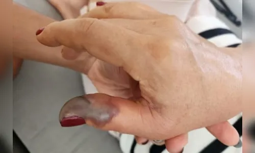 
							Após fazer a unha, mulher tem infecção e passa por 4 cirurgias
						
						