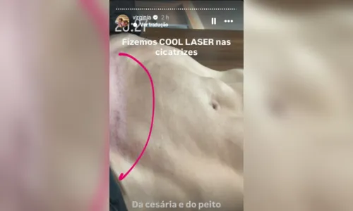 
							Virginia mostra cicatrizes e faz tratamento com esperma de salmão
						
						
