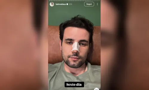 
							Ex-BBB Matteus Amaral mostra como ficou seu nariz após plástica; veja
						
						
