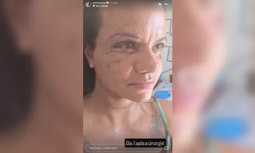 
							Mulher atacada com 61 socos mostra rosto após cirurgia facial
						
						