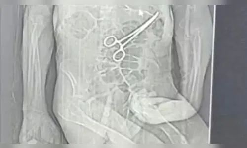 
							Idoso morre após pinça cirúrgica ser esquecida no corpo; veja foto
						
						