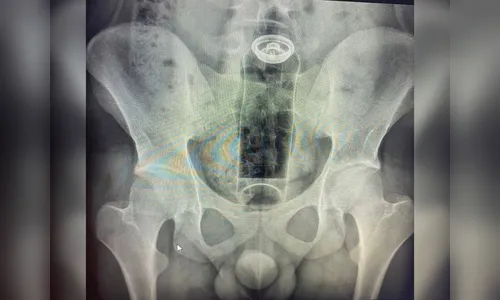 
							Jovem de 19 anos é internado após desodorante ficar preso no ânus; veja foto
						
						