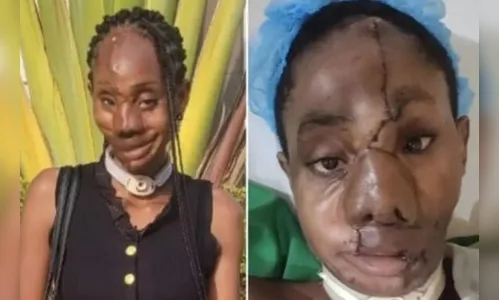 
							Jovem se recupera após ter rosto partido ao meio por 5 tiros; veja fotos
						
						