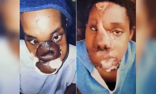 
							Jovem se recupera após ter rosto partido ao meio por 5 tiros; veja fotos
						
						