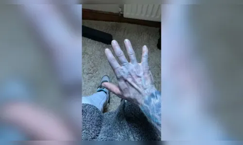 
							Homem se assusta ao acordar com pele azulada e diagnóstico surpreende
						
						