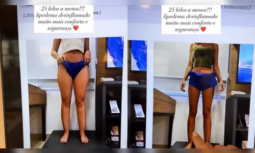 
							Yasmin Brunet mostra antes e depois de eliminar 25 quilos após diagnóstico; veja
						
						