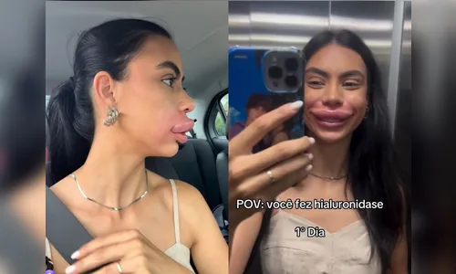 
							Miss de SC viraliza ao exibir inchaço extremo após procedimento estético nos lábios
						
						