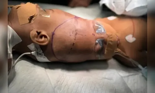 
							Gêmeas siamesas são separadas após mais de 40 horas de cirurgia com auxílio de IA; veja
						
						