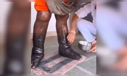 
							Homem passa 12 anos de pé por sacrífico religioso e inchaço das pernas impressiona; veja vídeo
						
						