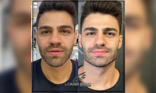 
							Dr. Cássio Bruno fala sobre o preenchimento de mandíbula
						
						