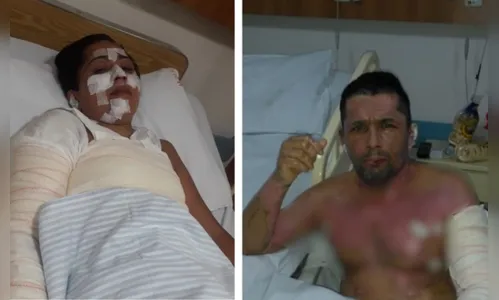 
							Sem gás, família se queima ao utilizar álcool para cozinhar
						
						