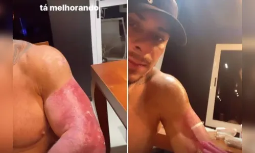 
							Leo Stronda mostra queimaduras após acidente doméstico
						
						