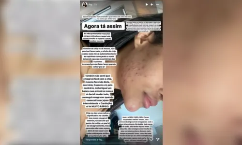 
							Ex-BBB desabafa sobre chip da beleza: 'Destruiu minha pele'
						
						