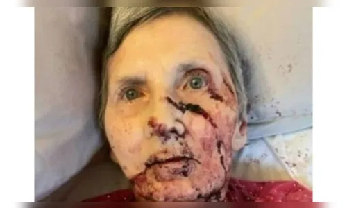 
							Idosa de 76 anos é atacada por ratazana enquanto dormia
						
						