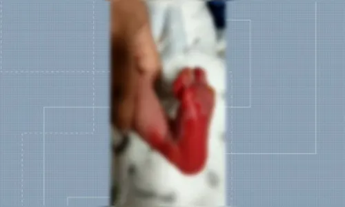 
						
							Família alega que recém-nascido sofreu queimaduras em teste do pezinho
						
						