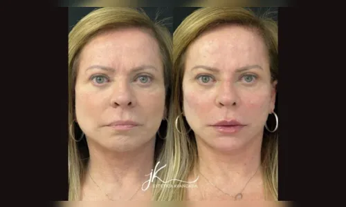 
							Aos 65 anos, Christina Rocha muda rosto com harmonização facial; veja
						
						