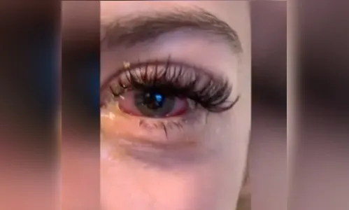 
							Após extensão de cílios, jovem fica com 'olhos de zumbi'; entenda
						
						
