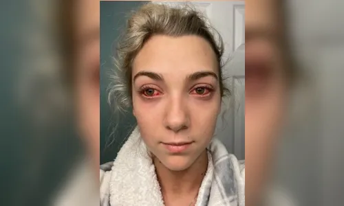 
							Após extensão de cílios, jovem fica com 'olhos de zumbi'; entenda
						
						