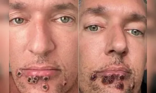 
							Monkeypox: ator compartilha fotos de evolução das feridas; Veja
						
						