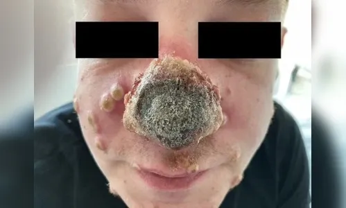 
							Nariz de homem com varíola dos macacos apodrece antes de diagnóstico
						
						