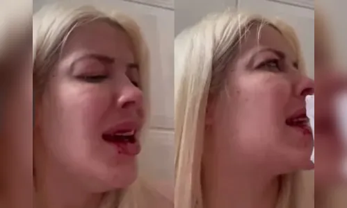 
							Ex-BBB surge machucada e acusa namorado de agressão e furto
						
						