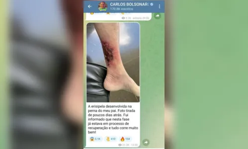 
							Erisipela: Carlos posta foto da perna de Bolsonaro com doença cutânea
						
						