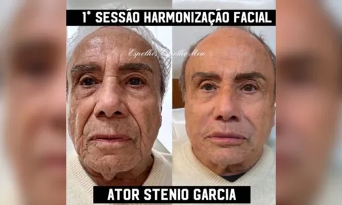 
						
							Stênio Garcia surpreende ao fazer harmonização facial; veja como ficou
						
						