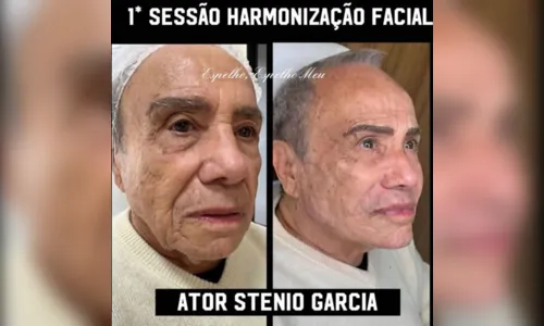 
						
							Stênio Garcia surpreende ao fazer harmonização facial; veja como ficou
						
						