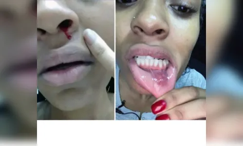 
						
							Patrícia Ramos mostra fotos de hematomas após suposta agressão do ex
						
						