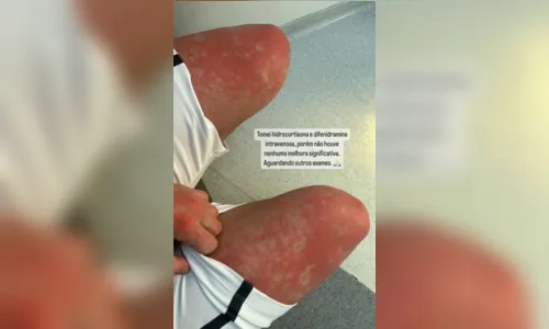 
						
							Influencer é internado com manchas no corpo; médicos não sabem o que é
						
						