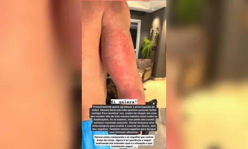 
						
							Influencer é internado com manchas no corpo; médicos não sabem o que é
						
						