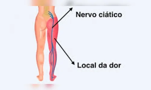 
						
							Dor no nervo ciático: o que é, sintomas e causas
						
						