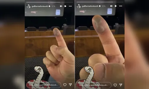 
							Guilherme Fontes mostra seu dedo após ser picado por Jararaca
						
						