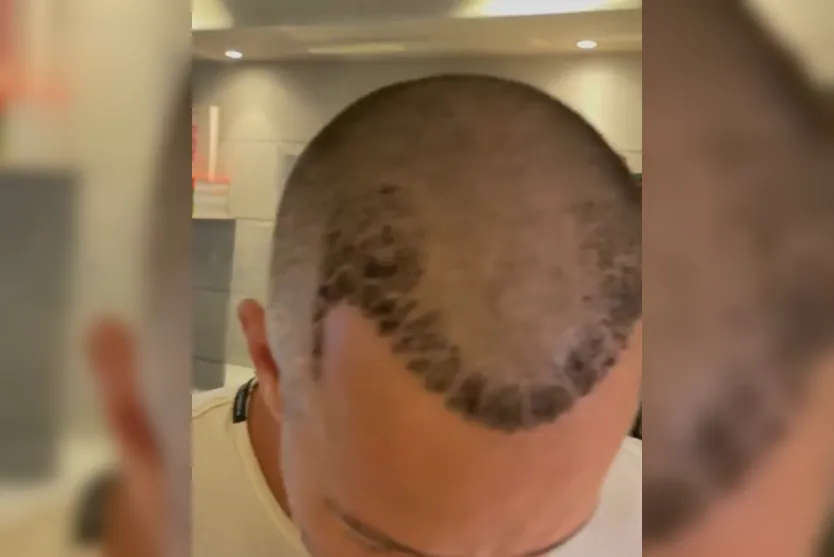 Malvino Salvador mostra resultado de transplante capilar