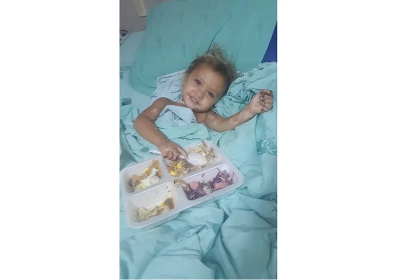 Bebê queimada em brincadeira com irmão vai receber alta