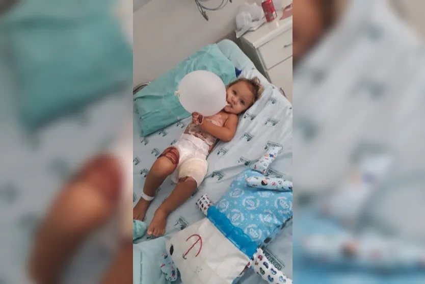 Bebê queimada em brincadeira com irmão vai receber alta