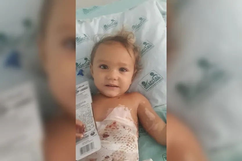 Bebê queimada em brincadeira com irmão vai receber alta