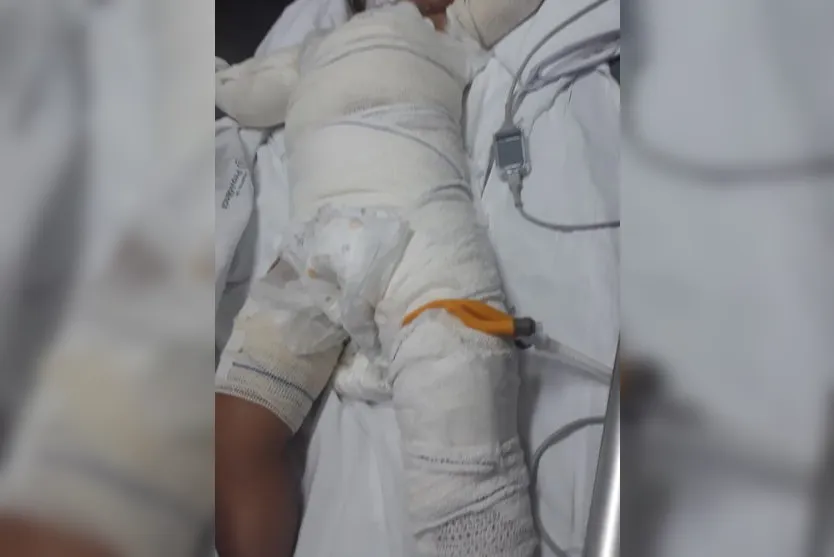 Mãe explica como filho ateou fogo na irmã de 1 ano