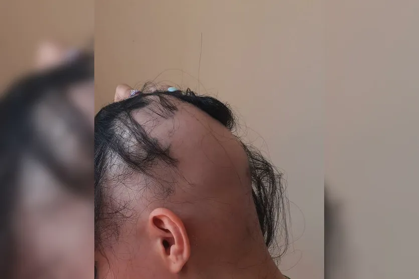 Alopecia: Jovem de Apucarana sofre com doença